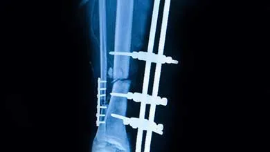 Close-up X-ray of a fractured lower leg bone with an internal plate and screws, plus an external fixator.